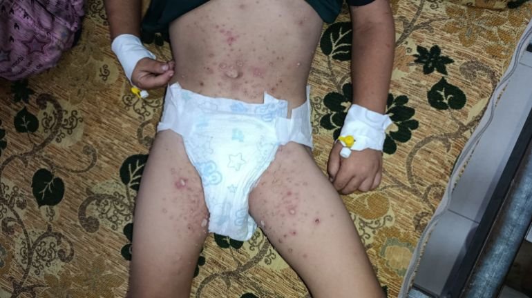 طفل يعاني من طفح جلدي شديد ومؤلم منتشر يتلقى علاجًا وريدًا