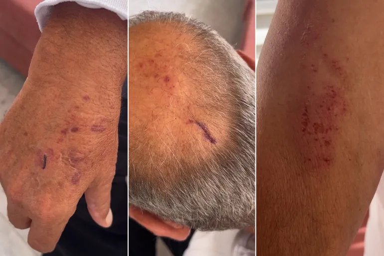 مستوطنون يعتدون بالضرب على محافظ بيت لحم الأسبق عبد الفتاح حمايل